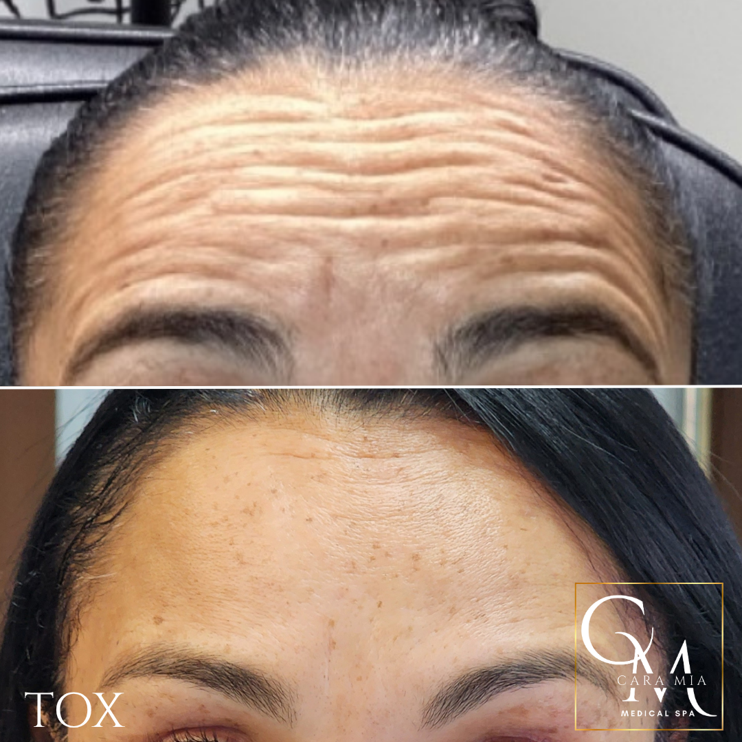 Forehead before and after a cosmetic procedure to smooth wrinkles.