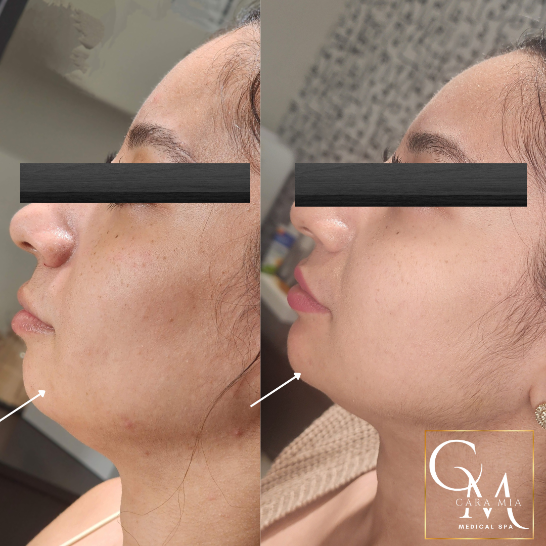 Side-by-side comparison of a person's jawline before and after a cosmetic procedure.