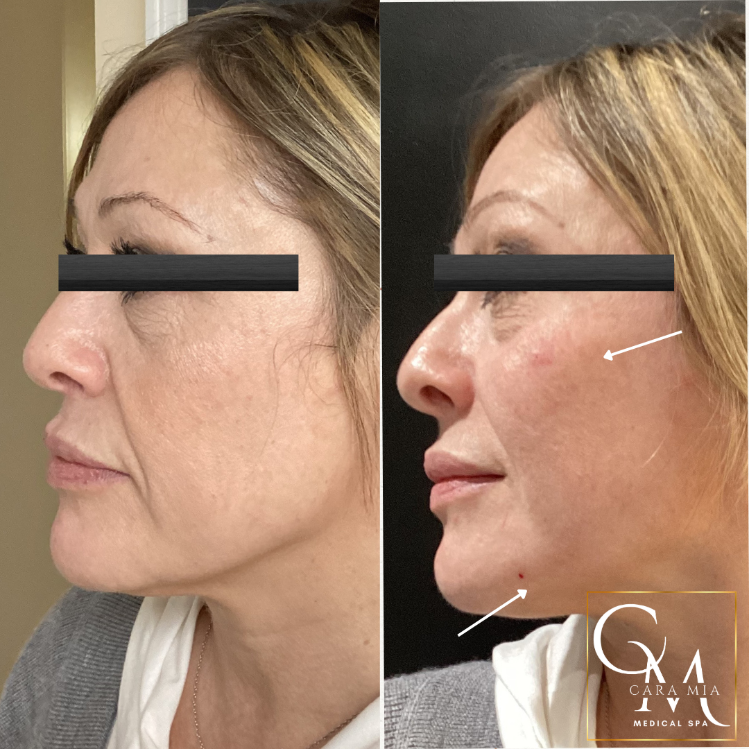Before and after photos of a woman's face, highlighting facial filler injection sites.