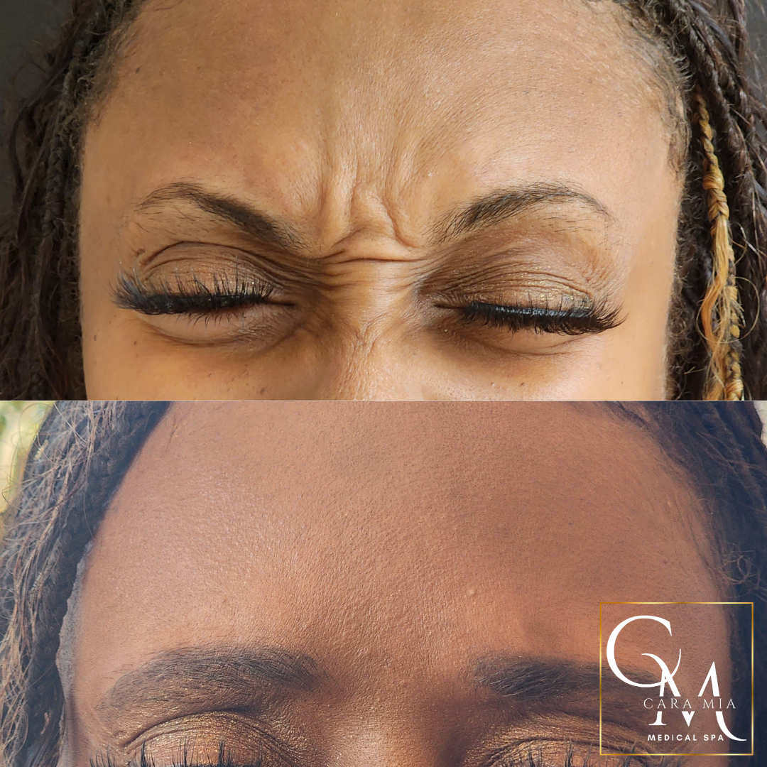 Top: Person with closed eyes, furrowed brow, wrinkles. Bottom: Same person, smooth forehead.