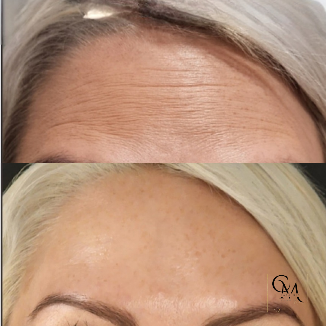 Forehead with wrinkles before and after treatment, showing smoother skin.