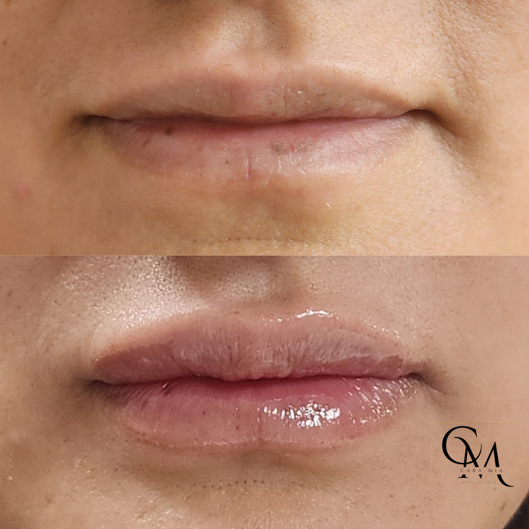 Before and after lip filler: top lips are thin, bottom lips are plump and glossy.