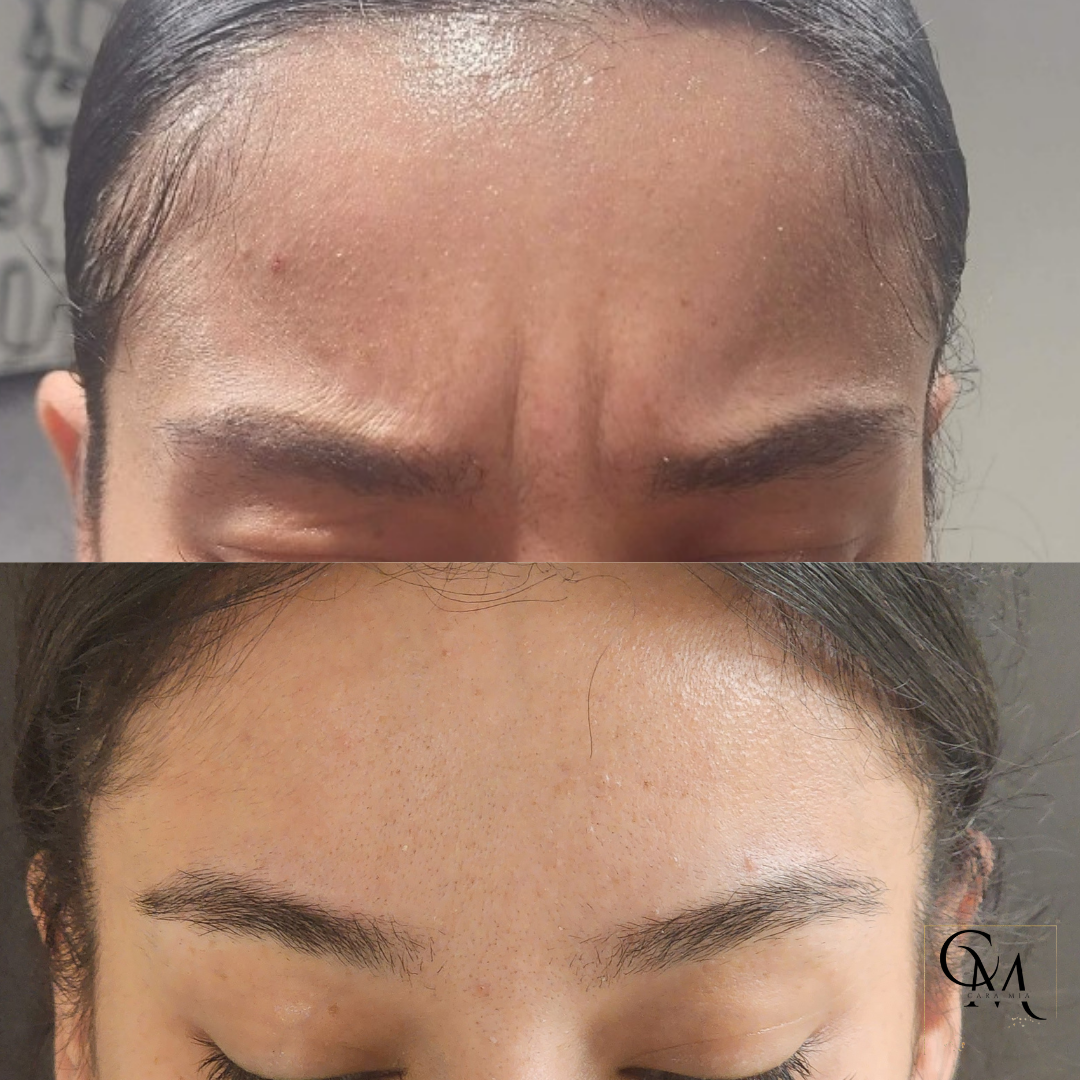 Before and after of a person's forehead, showing reduction of wrinkles after treatment.