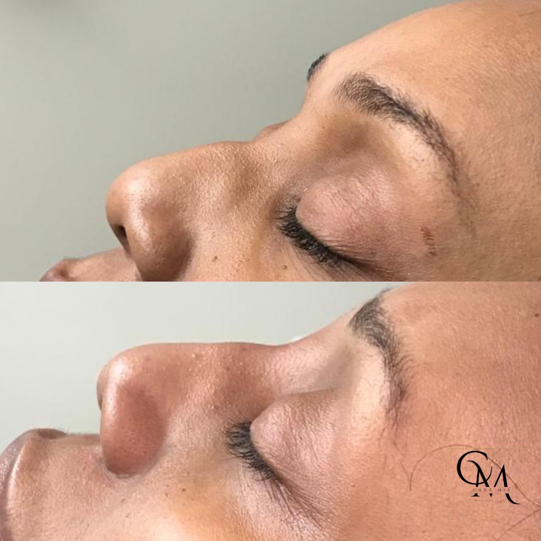 Before-and-after of a nose profile; bump reduction, lifting of the tip, cosmetic procedure.