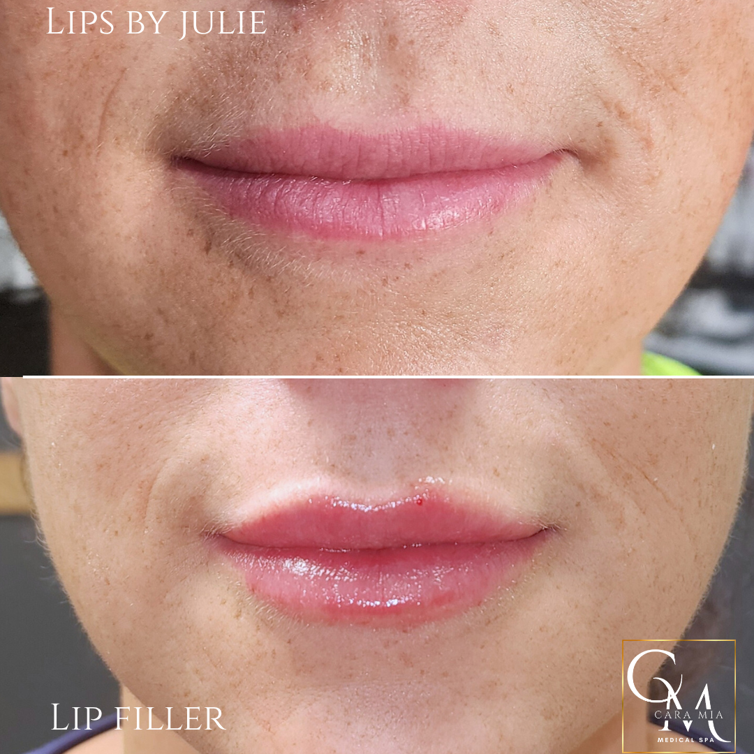 Before and after lip filler photos. The after shows fuller, more defined lips.