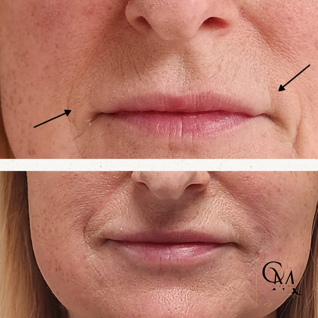 Before and after comparison of lip wrinkles, with arrows highlighting the reduction.