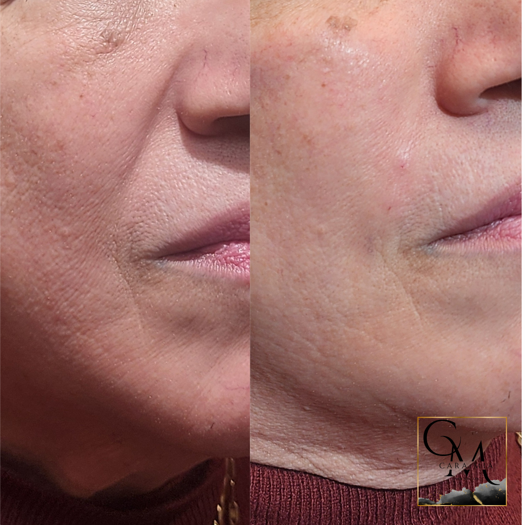 Before and after view of a person's cheek and jawline, showing reduced wrinkles after a procedure.
