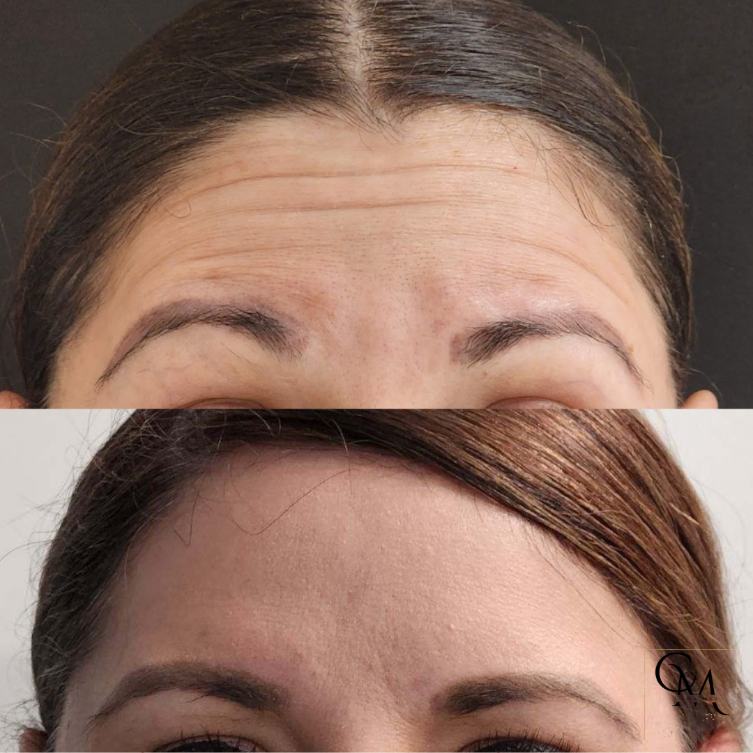 Top: Forehead with wrinkles. Bottom: Smoother forehead. Botox treatment comparison.