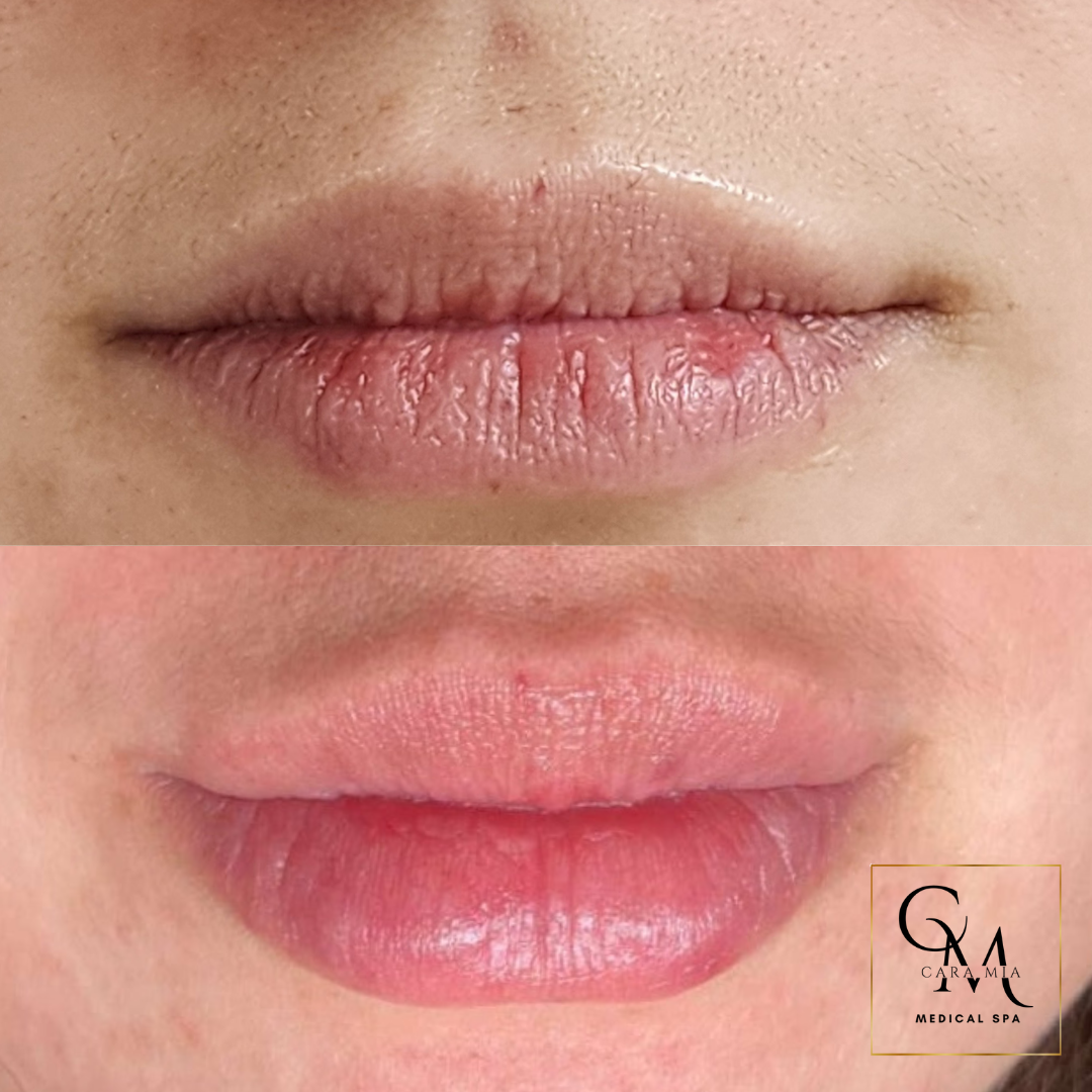 Before and after shots of lips, showing a fuller lip appearance in the 
