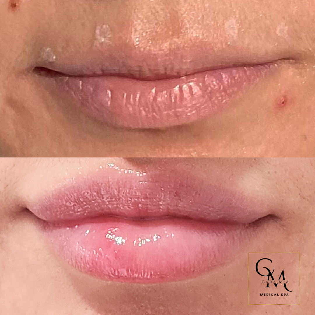 Lip augmentation comparison: upper lips are thinner, lower lips are fuller after treatment.