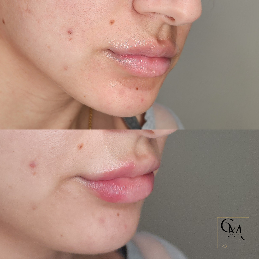 Comparison of lips before and after lip filler treatment, showing increased volume and shape.