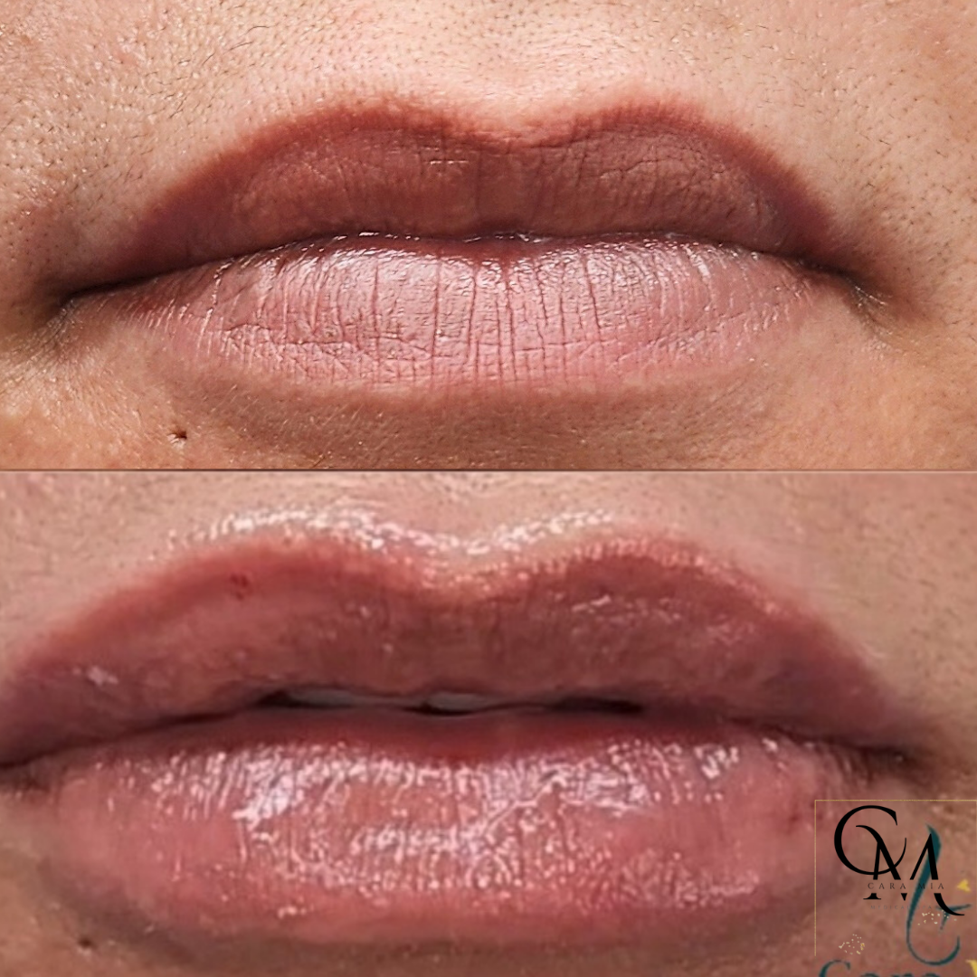 Comparison of lips: before (top) and after (bottom) lip filler treatment. Bottom lips are fuller and pinker.
