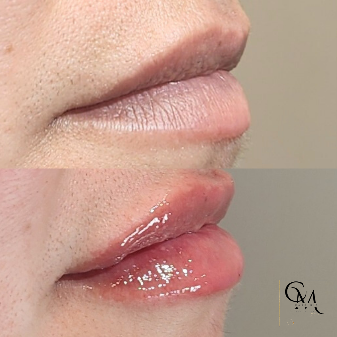 Comparison of lips: before (top) and after (bottom) lip gloss application. The 