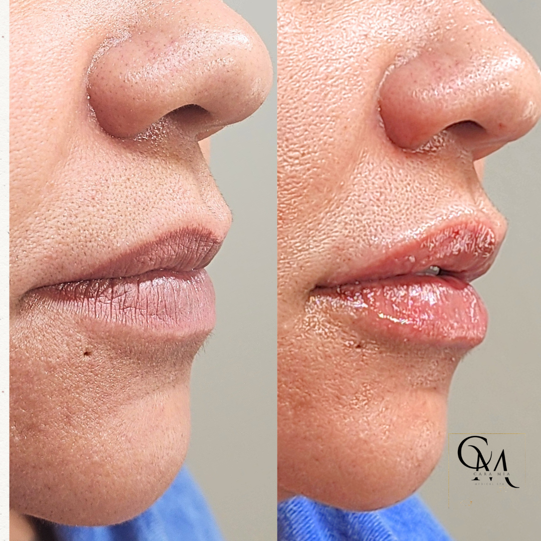 Before and after lip filler treatment: lips appear thinner in left image and fuller in right image.
