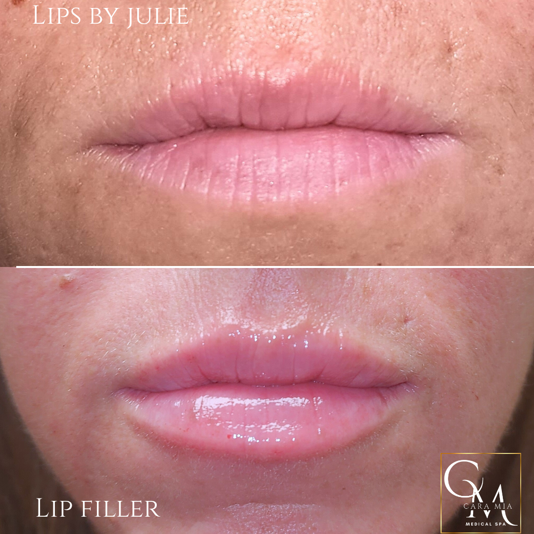 Comparison of lips before and after lip filler treatment. Top: thinner lips. Bottom: fuller, plumper lips.