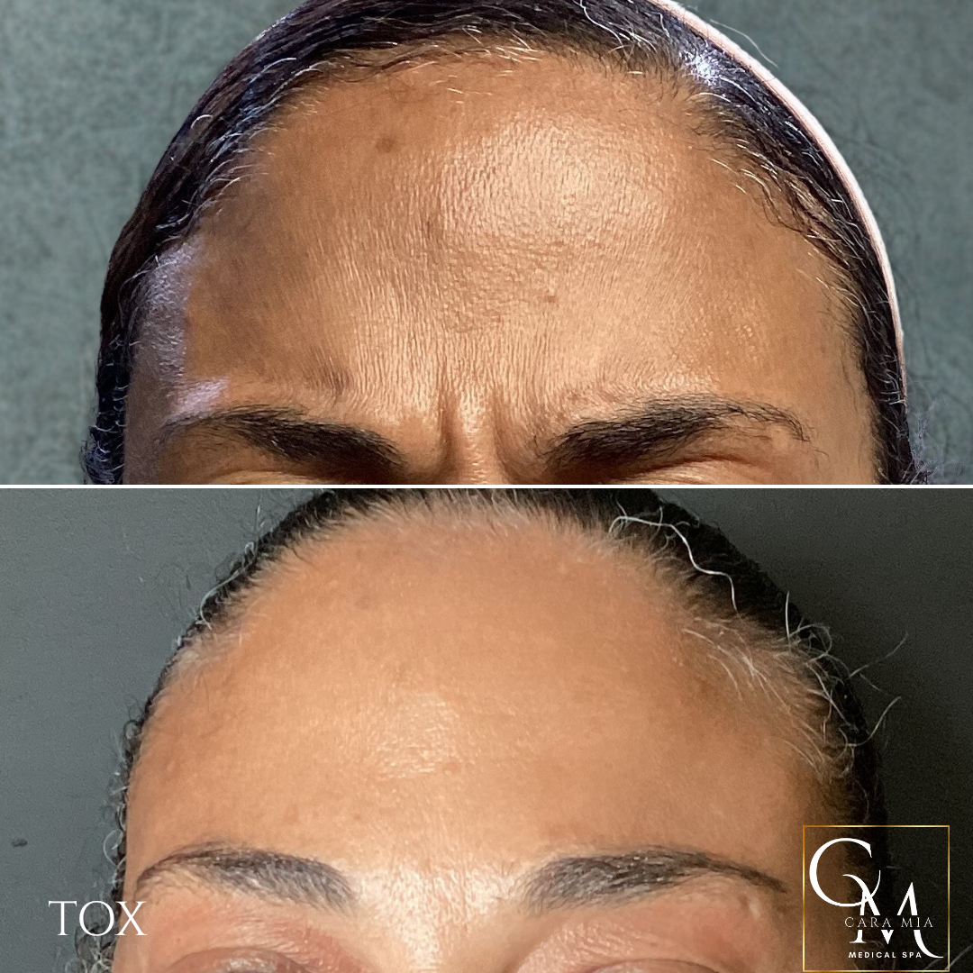 Comparison of woman's forehead before (wrinkled) and after (smooth) Botox treatment.