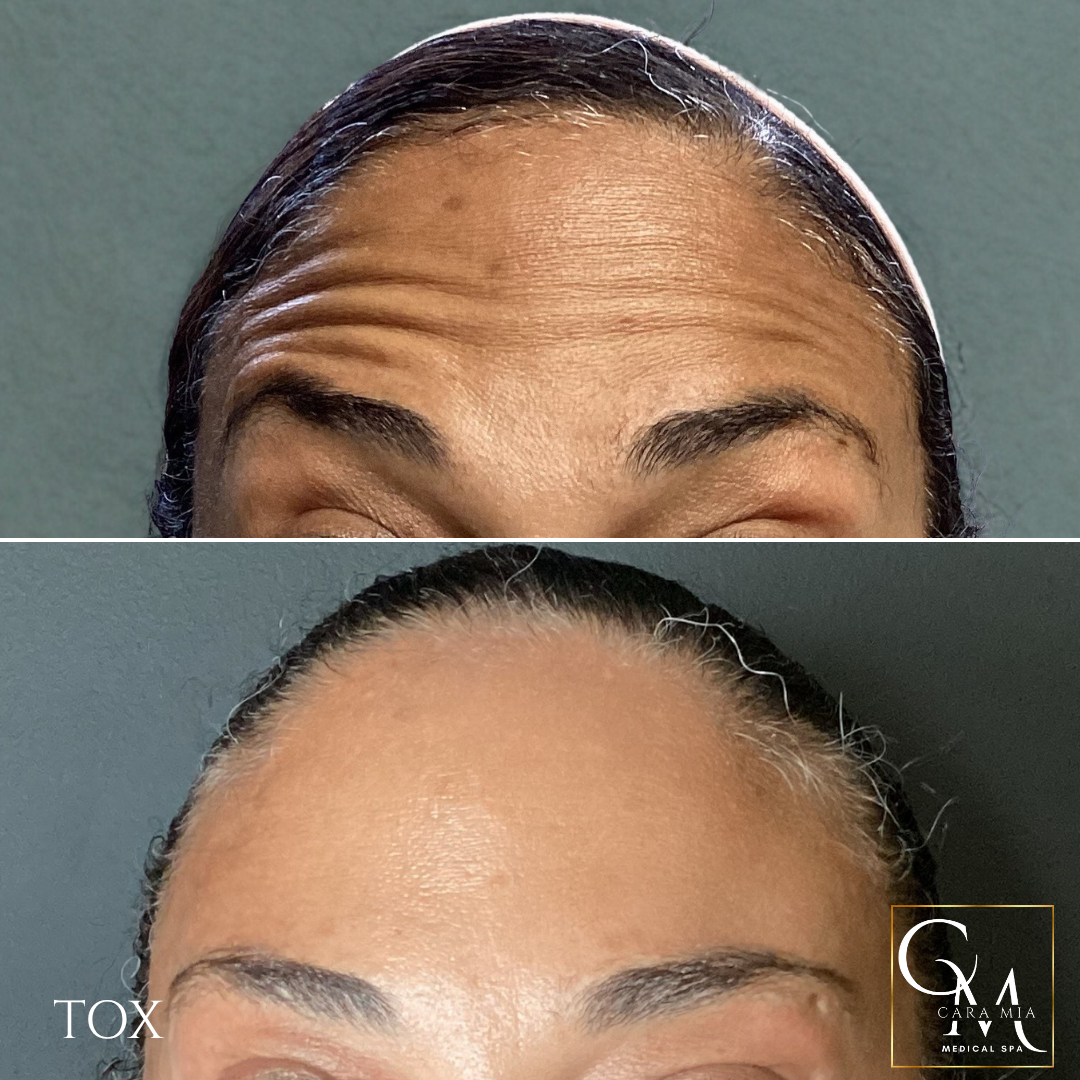 Before and after photos of a forehead; top shows wrinkles, bottom shows smooth skin.
