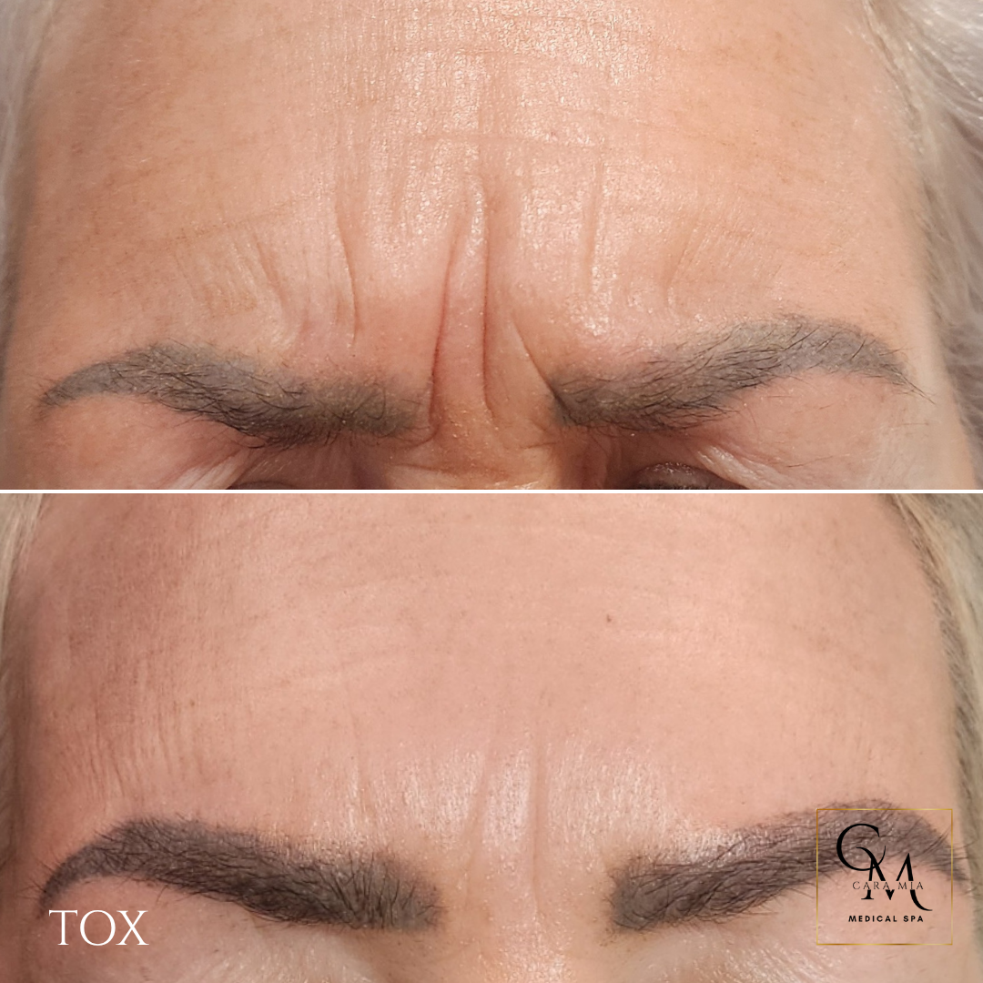 Top: Wrinkled forehead with deep lines. Bottom: Smoothed forehead after treatment, showing fewer wrinkles.