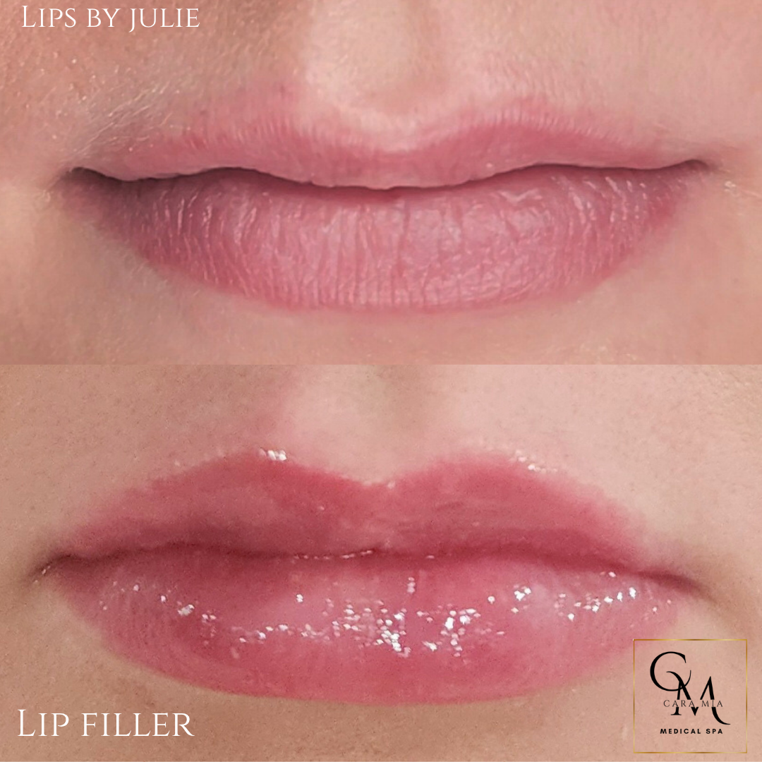 Comparison of before and after lip filler treatment: top, natural lips; bottom, fuller, glossy lips.