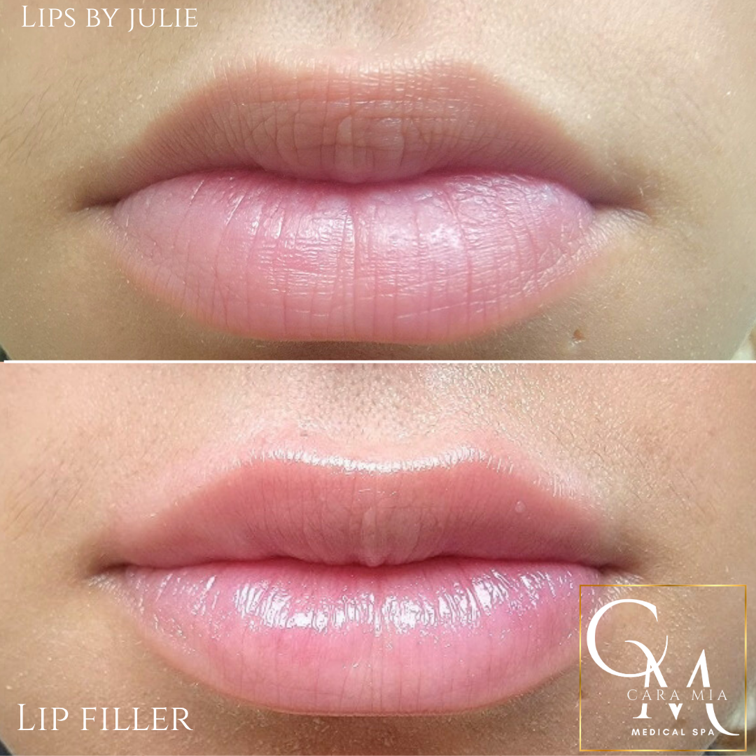 Before and after lip filler: top lips appear thinner, bottom lips fuller and more defined in bottom image.