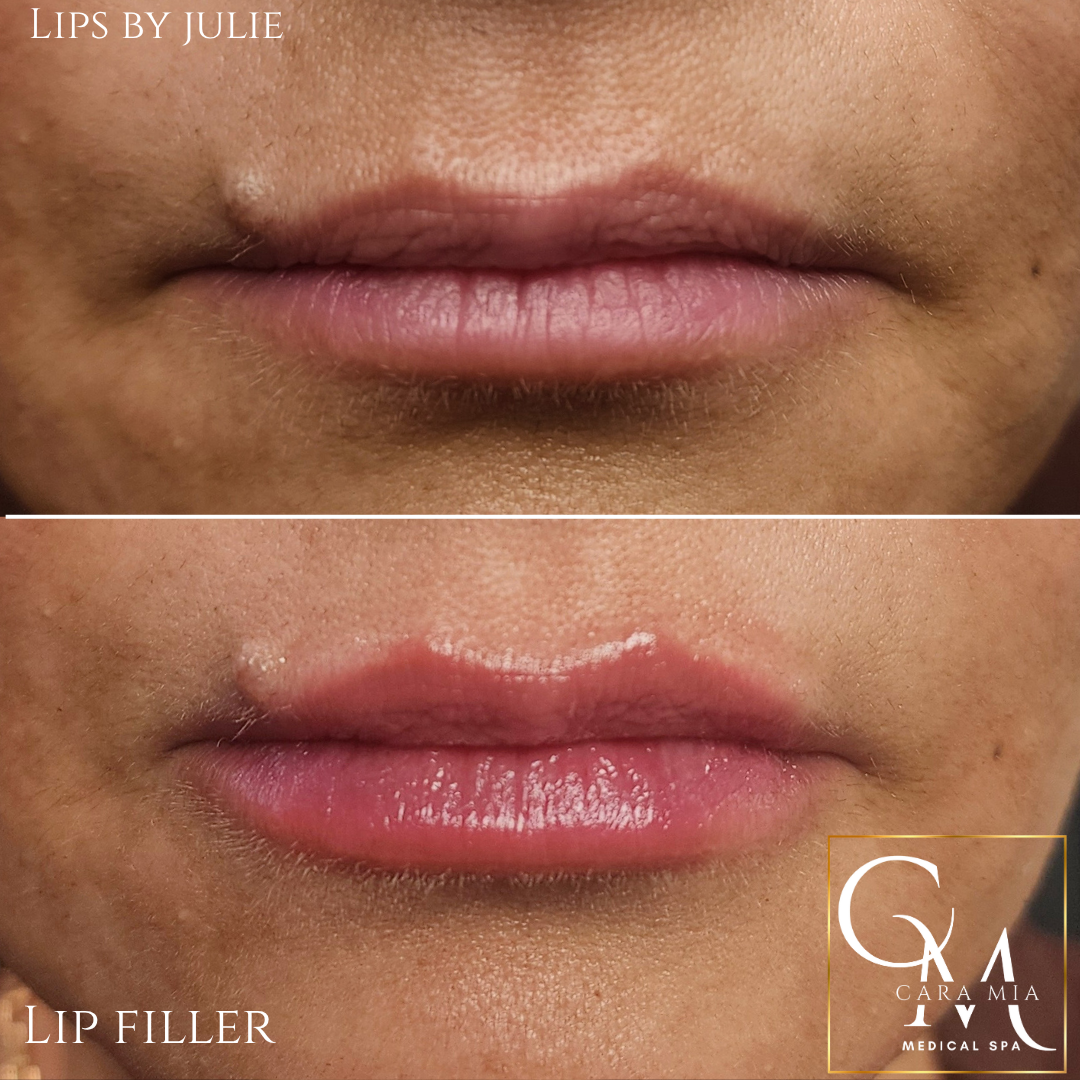 Before and after lip filler treatment: fuller, more defined lips.