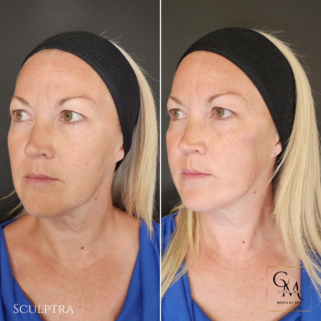 Side-by-side photos of a woman's face, showing a before and after treatment to reduce wrinkles and sagging skin.