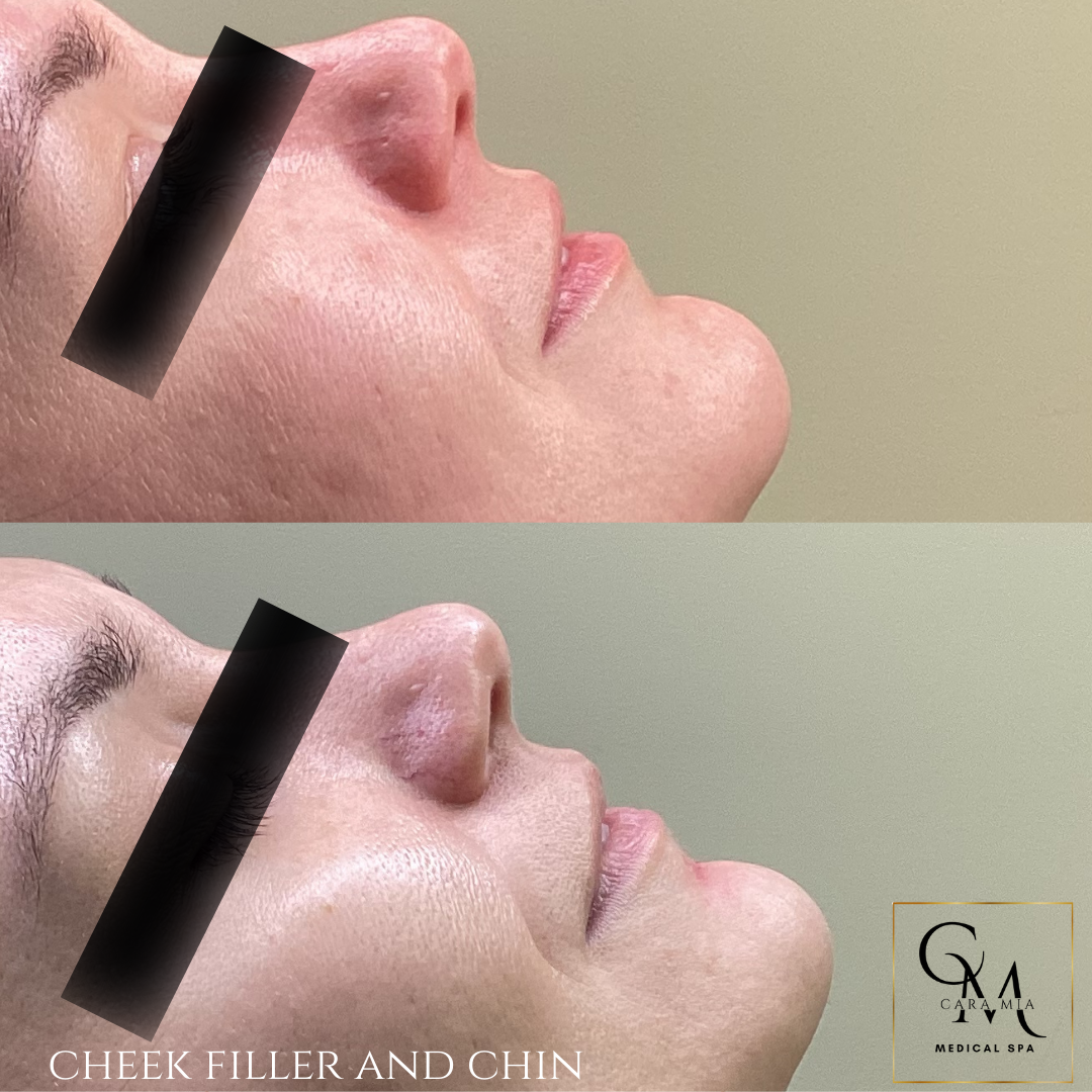 Two side-by-side profile views of a woman's face; before and after cheek and chin filler. Skin is light.