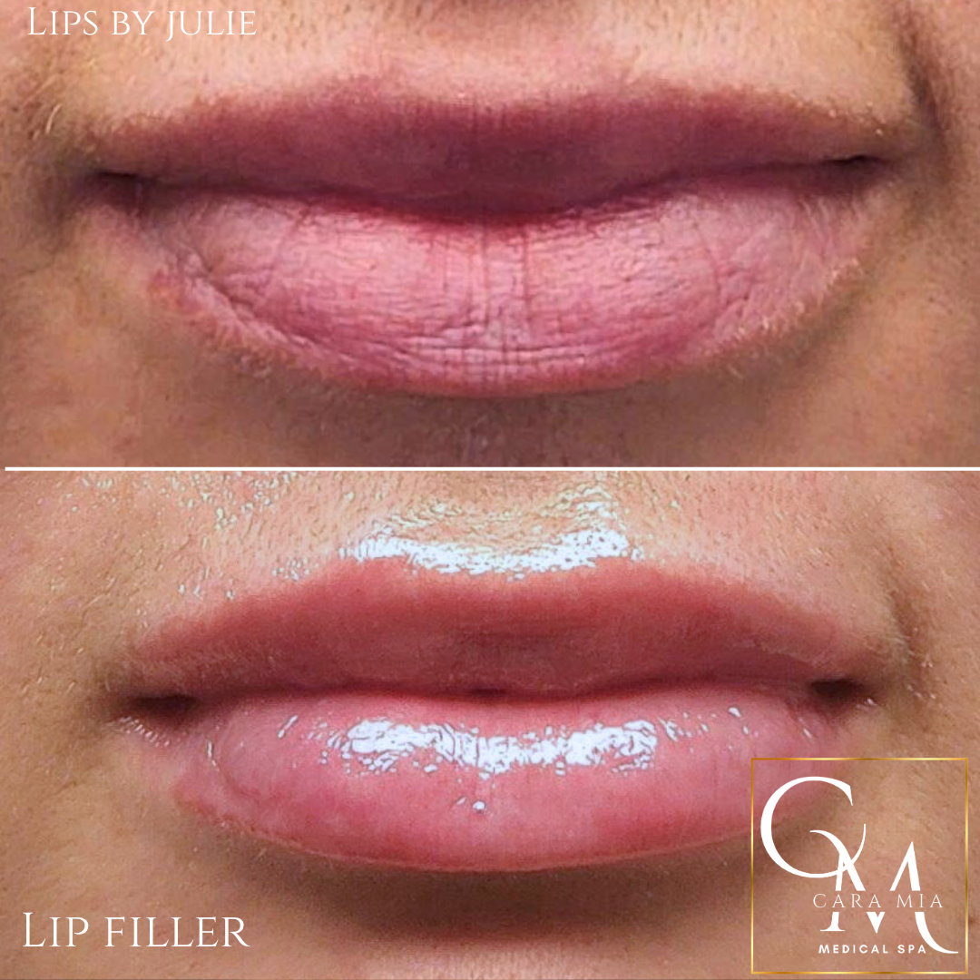 Comparison of lips before and after lip filler treatment. Bottom lips are fuller, glossier.