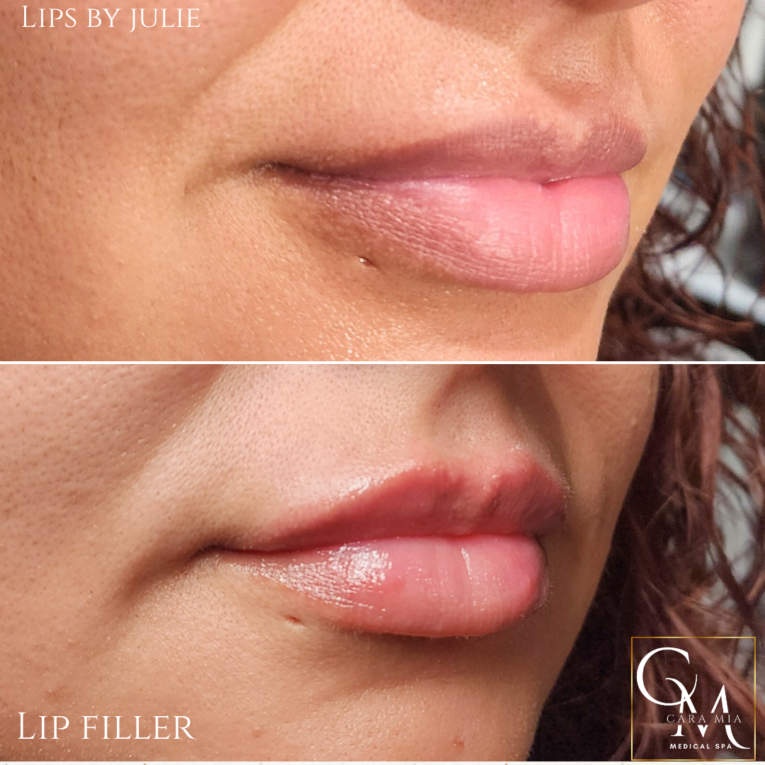 Before and after lip filler: top lips appear thinner, bottom lip fuller in lower image.