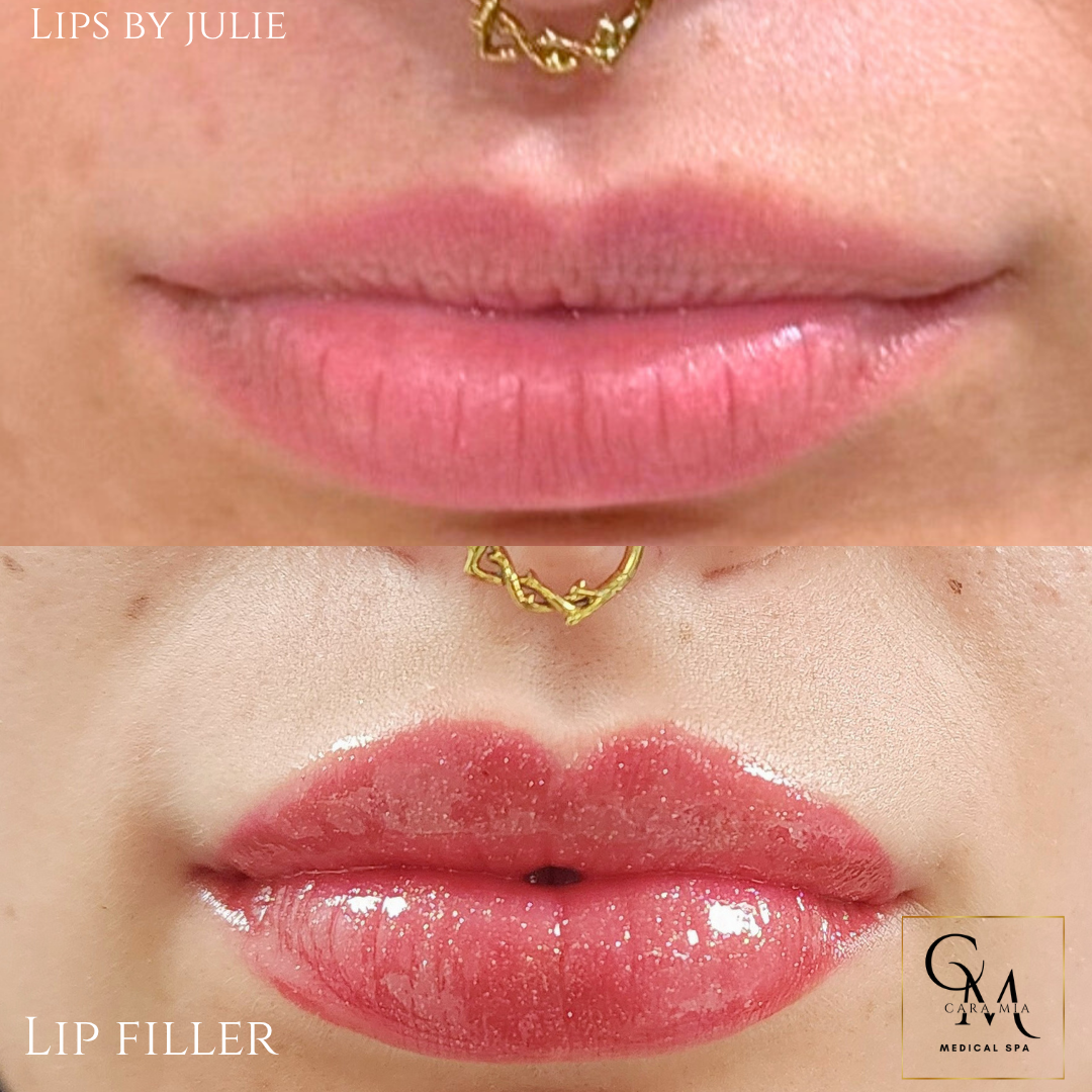 Two close-up photos of lips; top shows natural lips, bottom displays enhanced lips with lip filler.