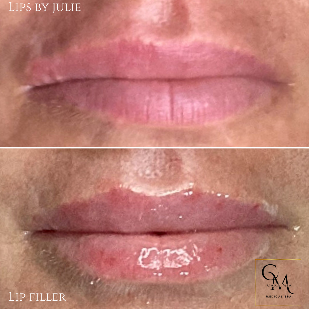 Before and after lip filler treatment: fuller lips, gloss application.