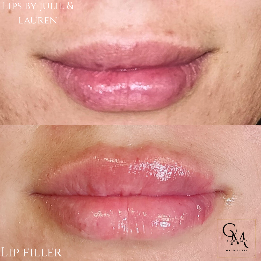 Before and after lip filler: top lips appear thinner, bottom lips are fuller, pink and glossy.