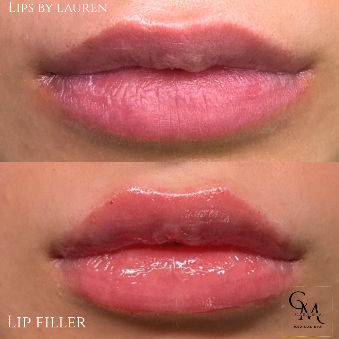 Before and after lip filler treatment: fuller, pink lips with glossy finish.