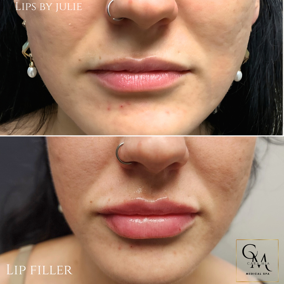 Before and after comparison of lip filler treatment. The after photo shows fuller lips.