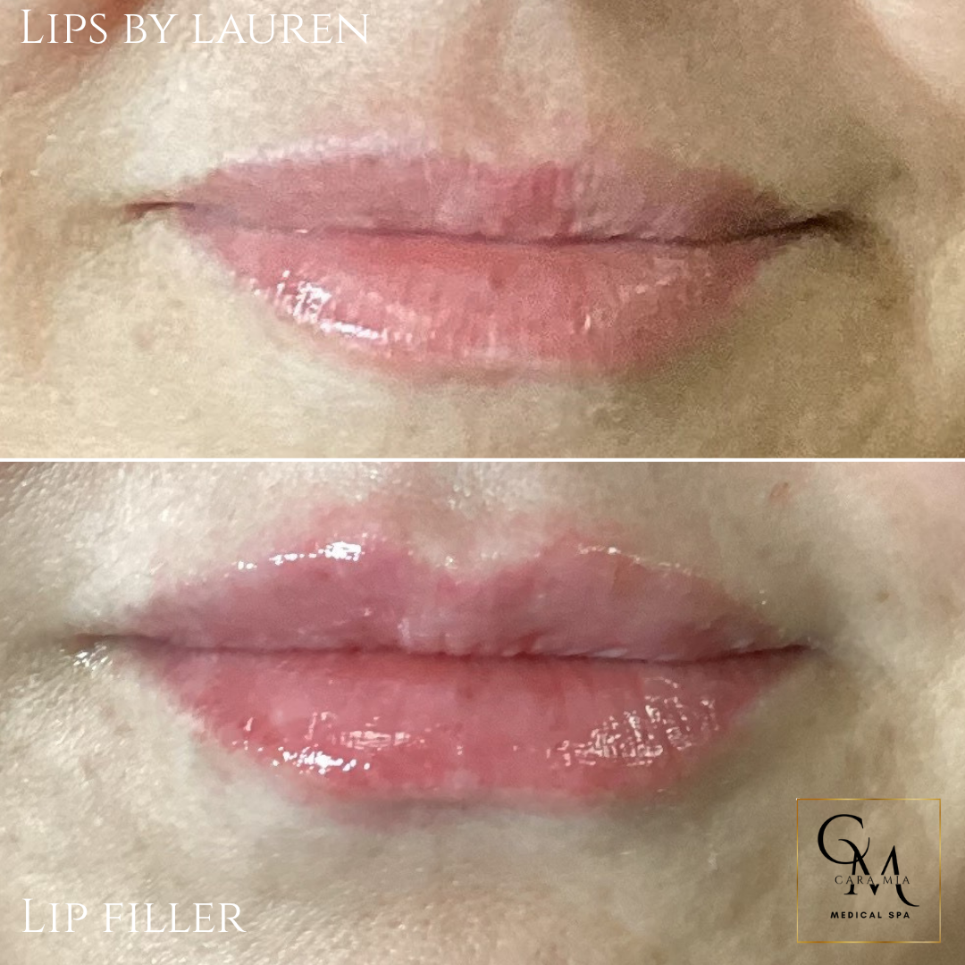 Comparison of before and after lip filler treatment; fuller, pink lips.