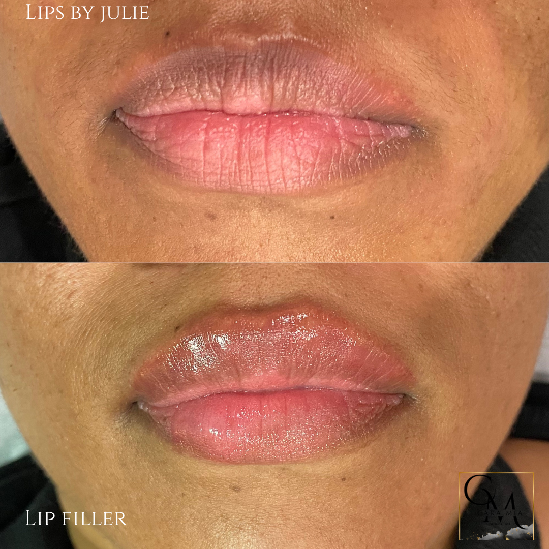 Before and after lip filler treatment: top, darker, dry lips; bottom, fuller, glossed lips.