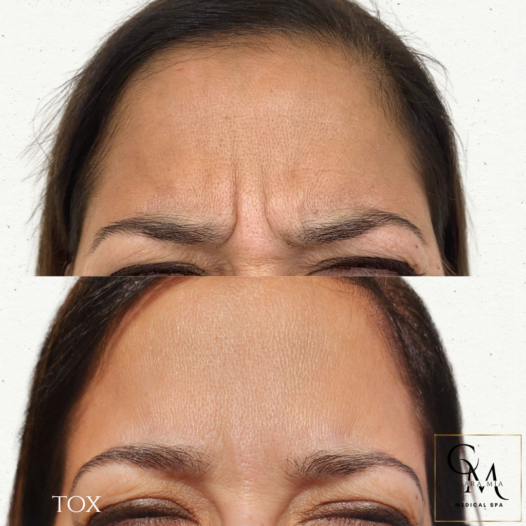 Forehead wrinkles before and after treatment, demonstrating smoother skin.