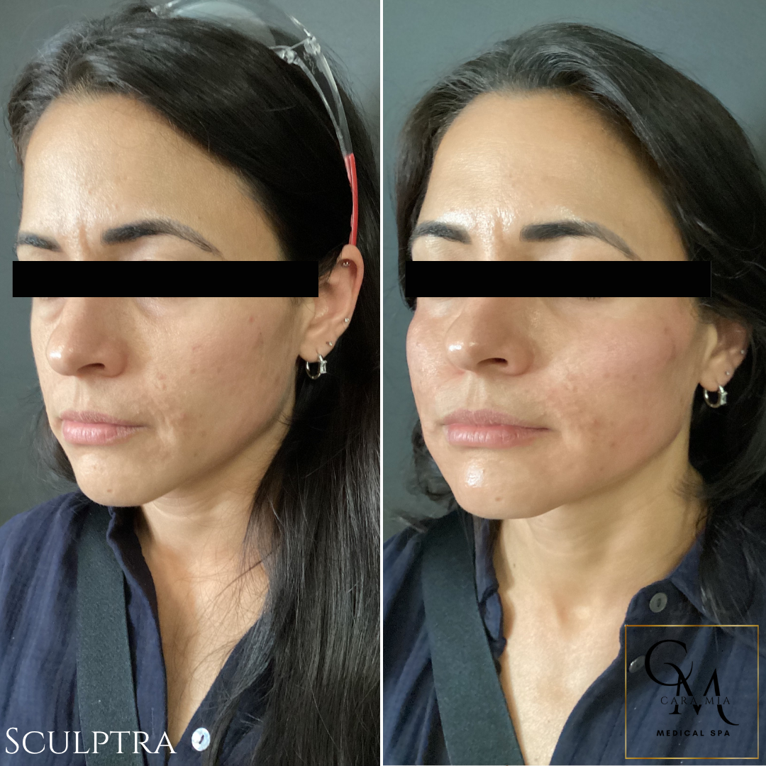 Before and after photos of a person's face; post-treatment shows fuller cheeks and reduced wrinkles.