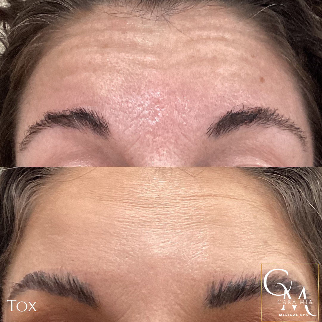 Before and after photo of forehead wrinkles, smoothed after treatment.