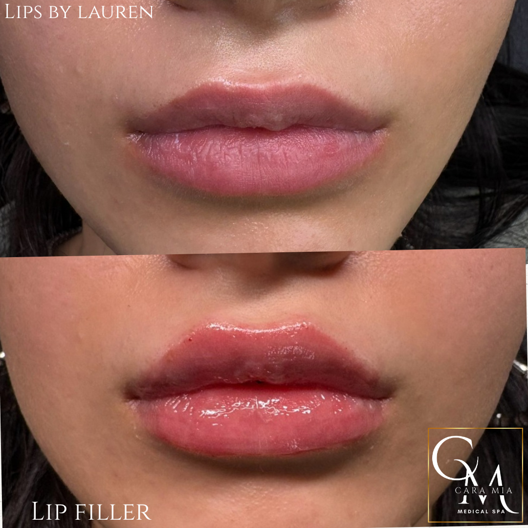 Comparison of lips before and after lip filler treatment; both sets are glossy, plump, and pink.