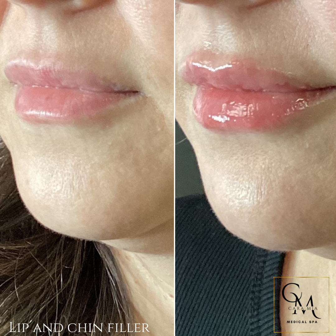 Side-by-side comparison of lips before and after lip filler treatment, showing increased plumpness and definition.