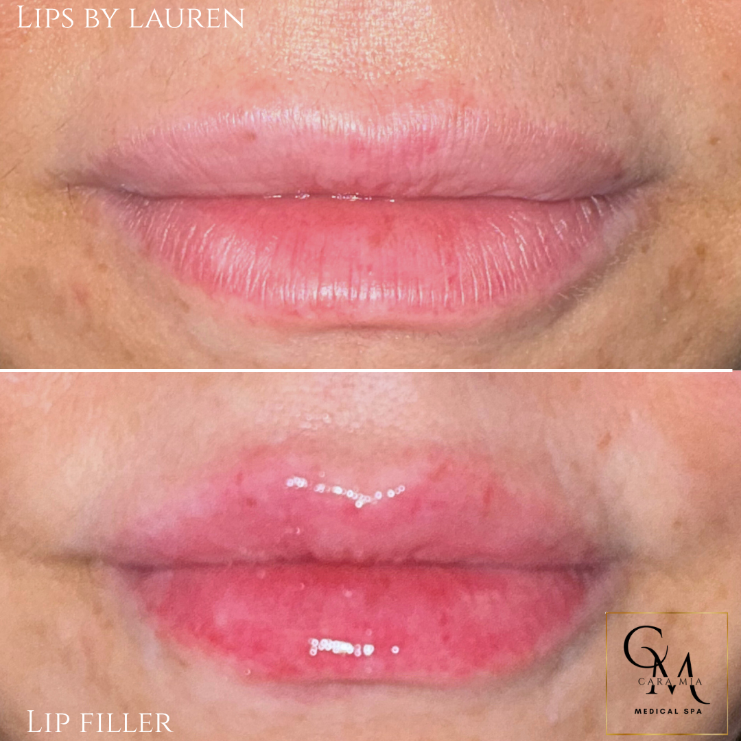 Comparison of lips before and after lip filler treatment; fuller, pink lips.