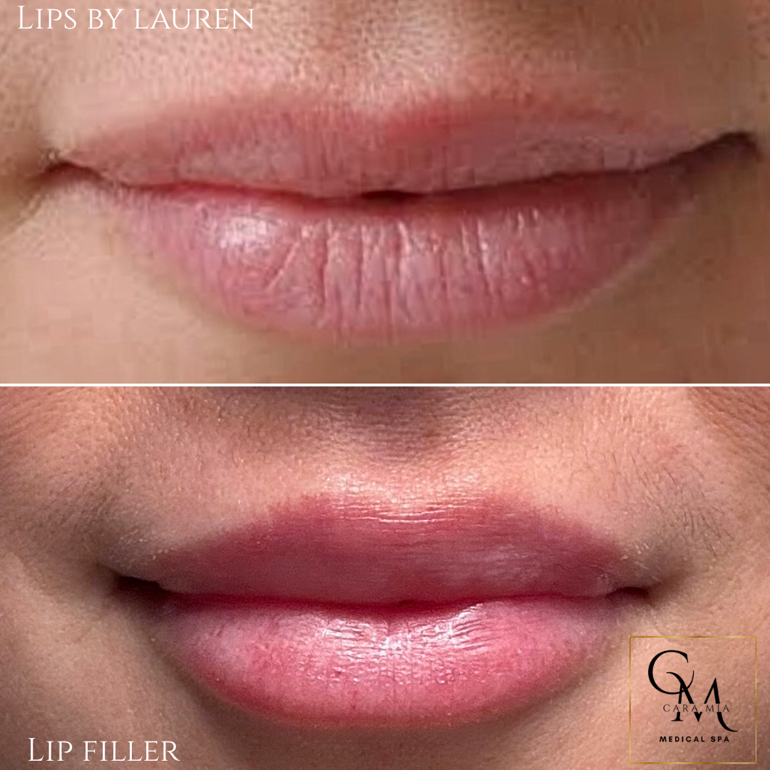 Before and after lip filler comparison: thin lips to fuller, pink lips.