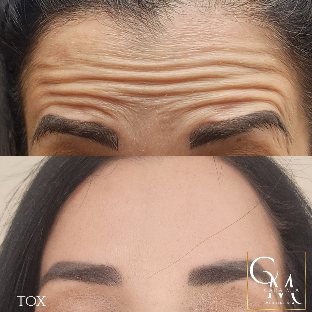 Forehead wrinkles before and after treatment. Smooth forehead after procedure.