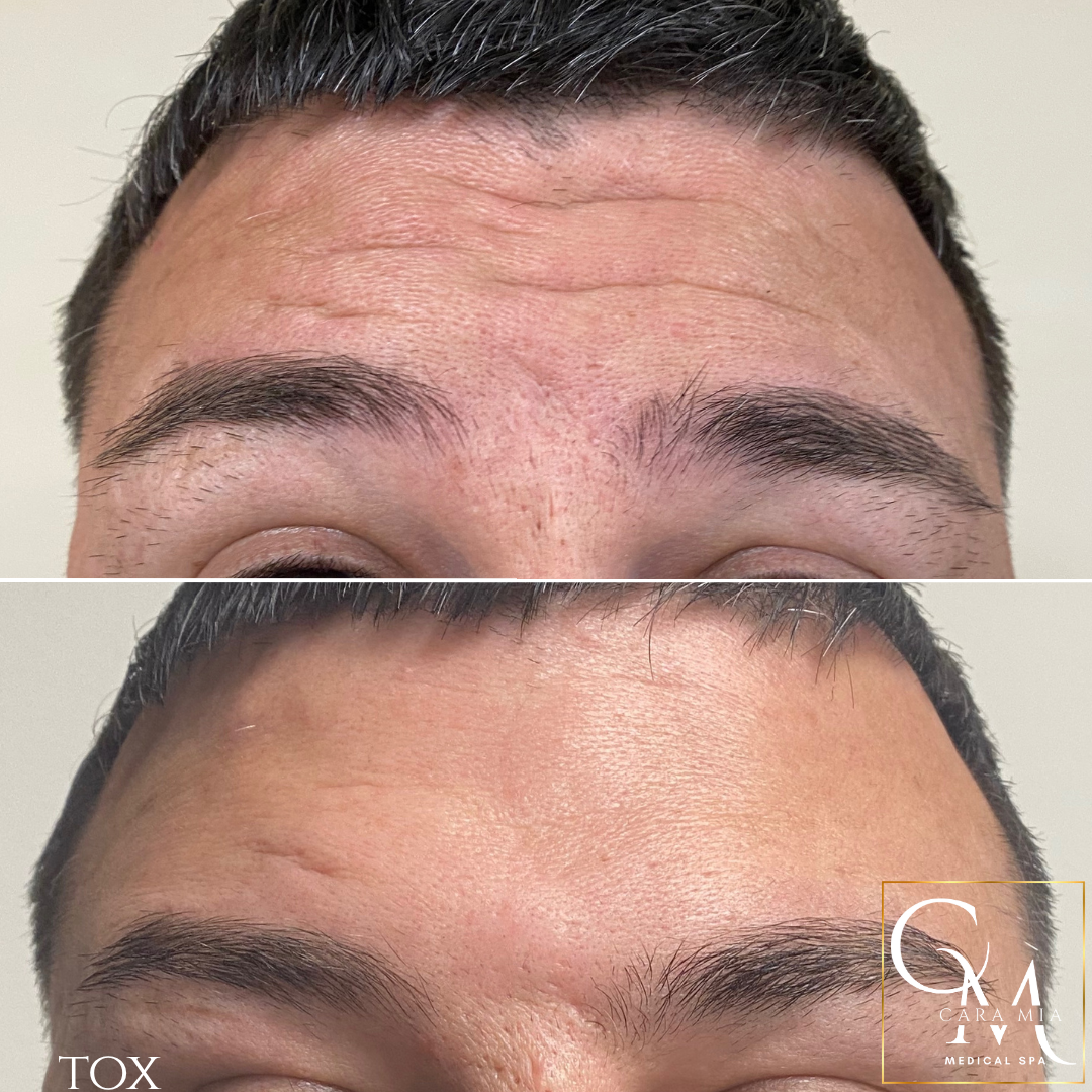 Forehead wrinkles before and after treatment, showcasing smoother skin.