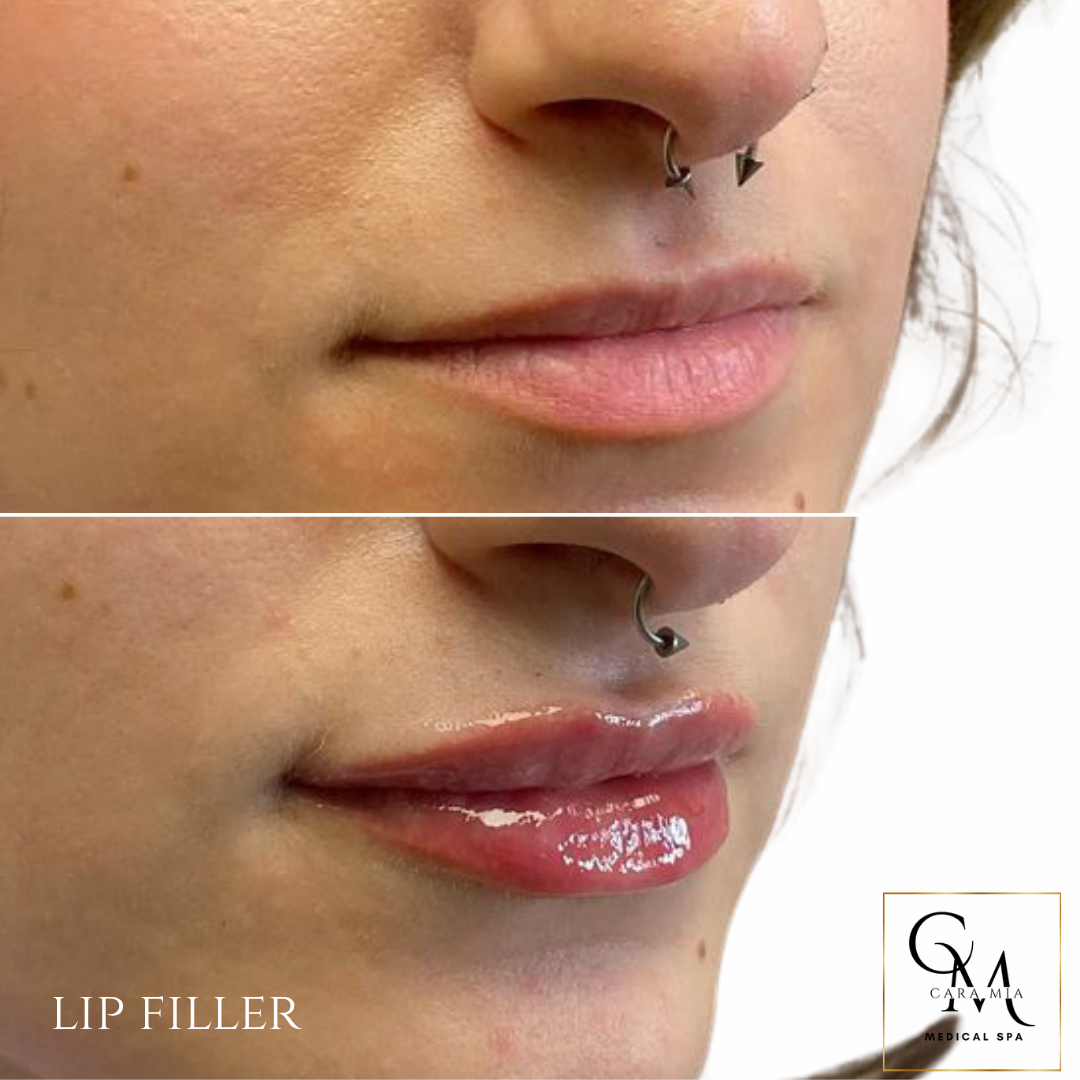Comparison of lips before and after lip filler treatment; top lips are smaller, bottom lips are fuller and glossy.