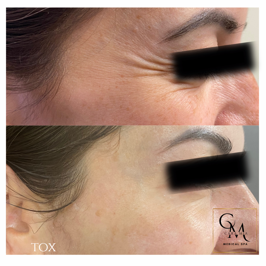 Before and after photos of wrinkles around the eye area, showing a smoother appearance after treatment.