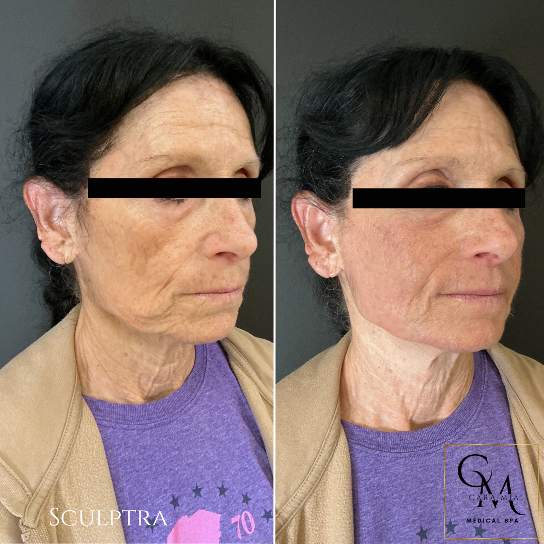 Side-by-side comparison of woman's face. Left side shows wrinkles, right side, skin is smoother after Sculptra.