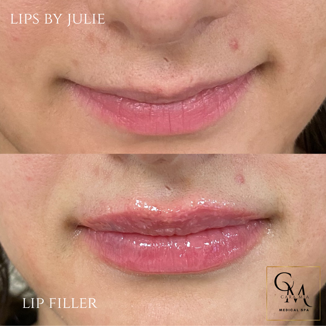 Before and after lip filler treatment: lips appear fuller and more defined.