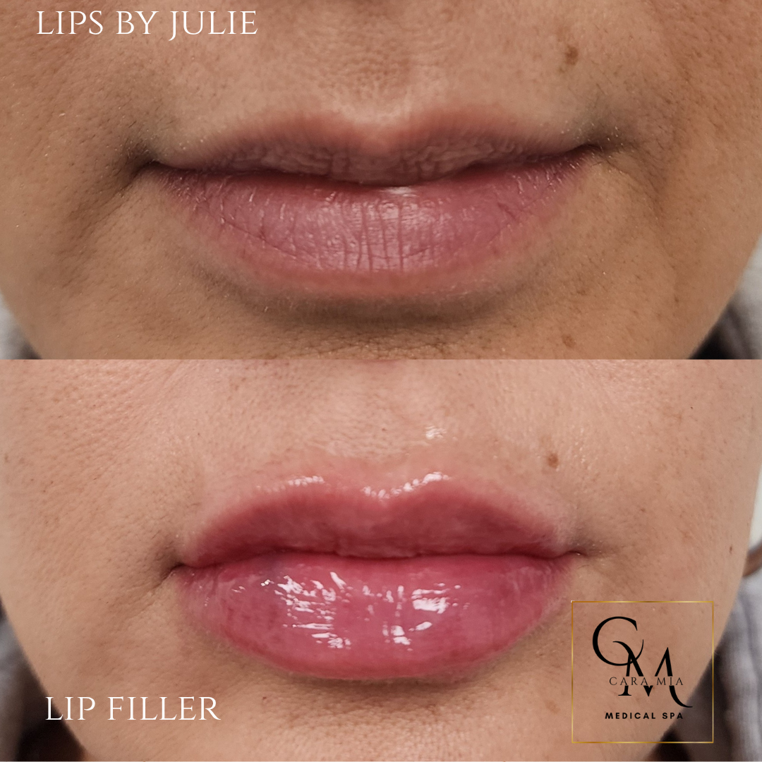 Before and after photos of lip filler; top: thin lips, bottom: plump, pink lips.